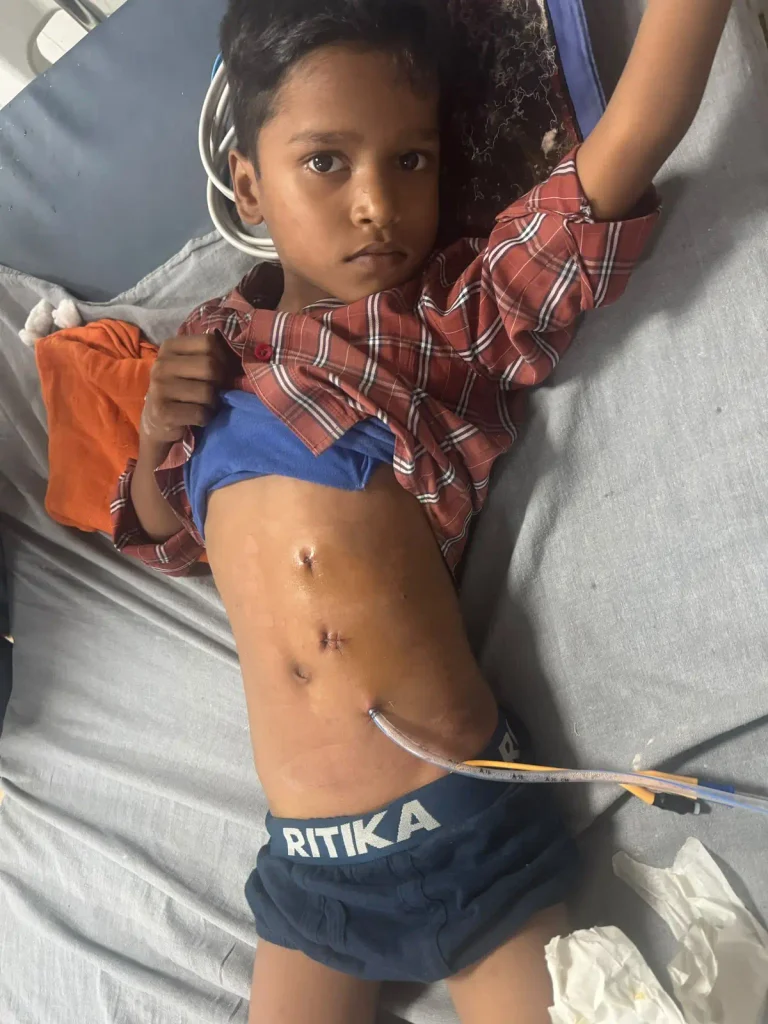 6 साल के बालक की बिना चीर-फाड़ दूरबीन से किडनी सर्जरी 2 1006802370 768x1024 1